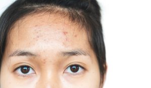 asian woman with pimples on forehead