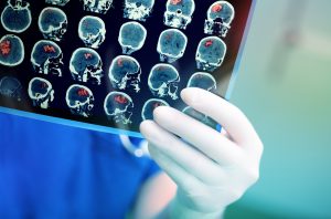brain cancer and brain tumour