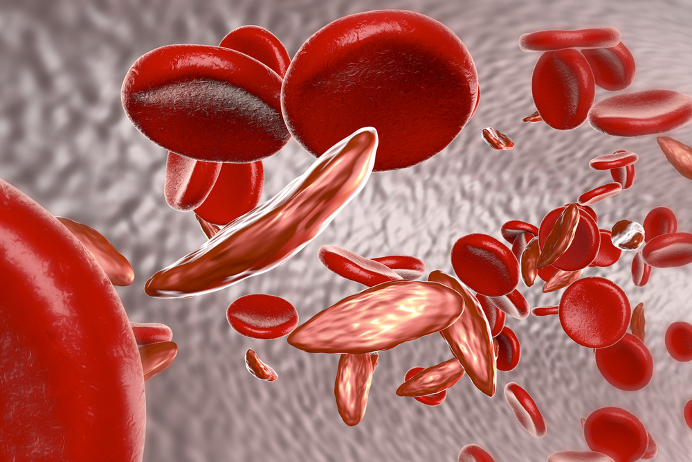 sickle cell disease anaemia