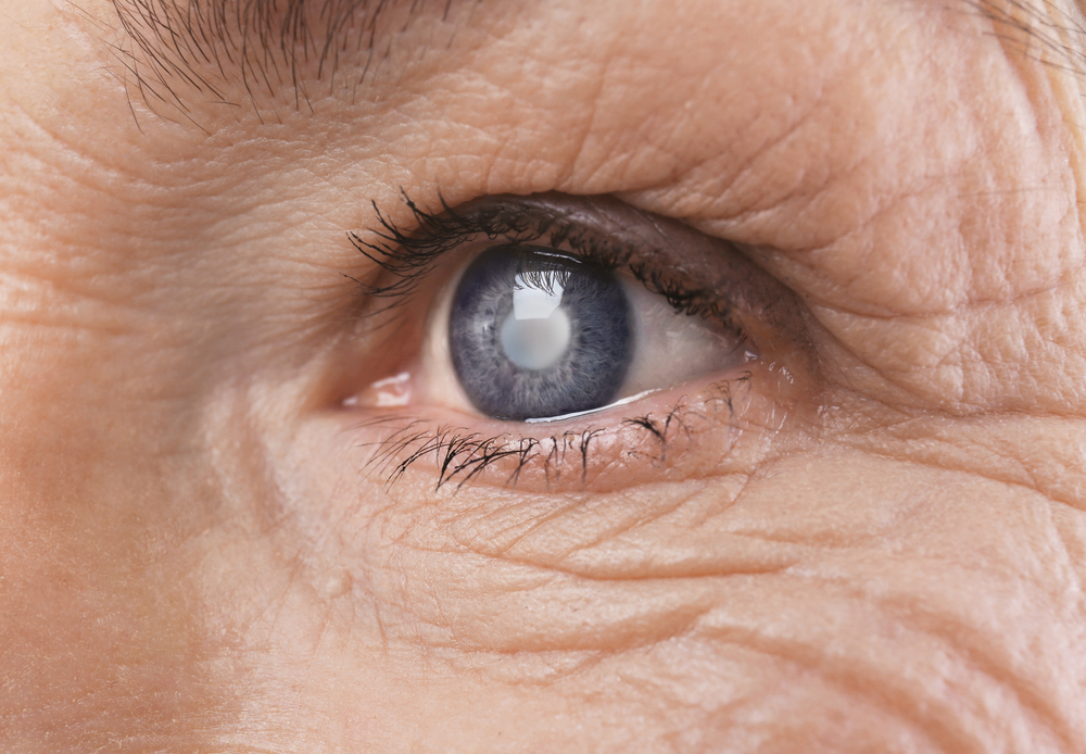 Cataracts: When Should You Remove Them?