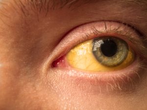 hepatitis yellowing of eyes