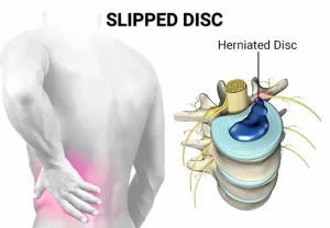 slipped disc