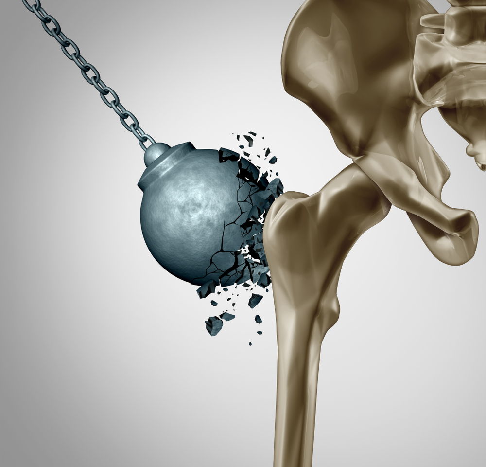 Osteopenia: Diagnosis and Treatment
