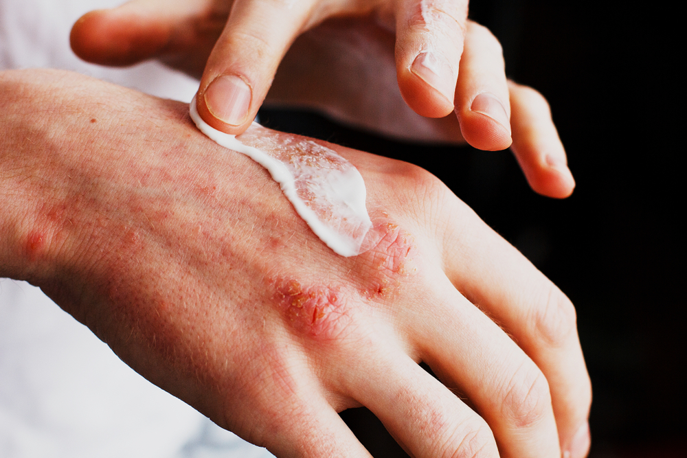 eczema atopic dermatitis