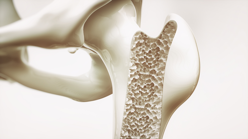 Osteoporosis: Why Is It More Common In Women?