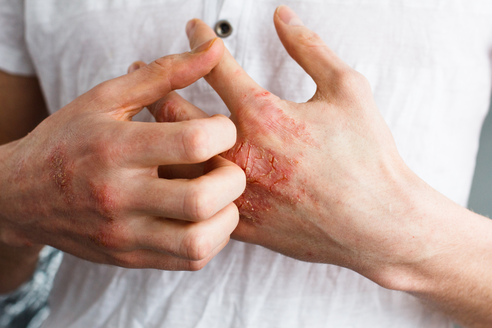 Eczema I: Types, Triggers and Prevention