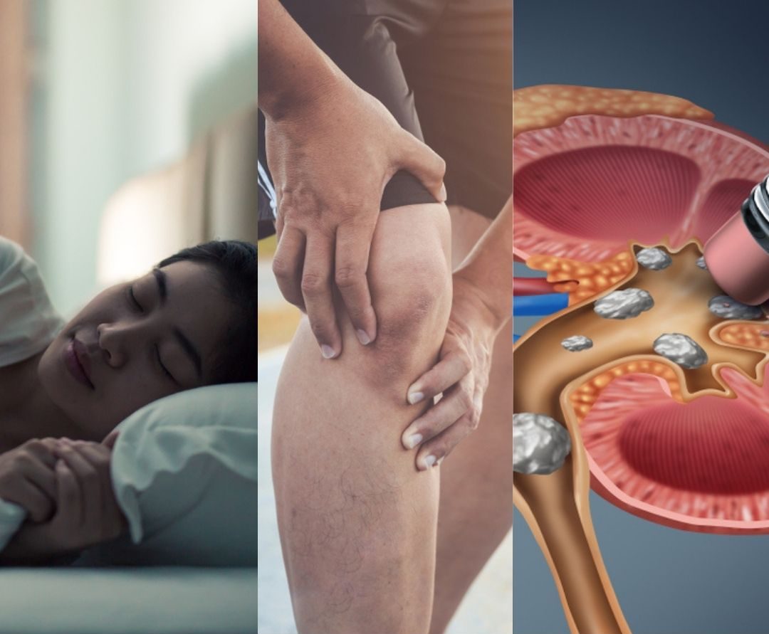 Sleep, Pain, Kidney Stones – Top Stories and Articles of 2021 for MCA