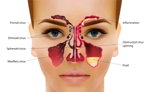 sinusitis