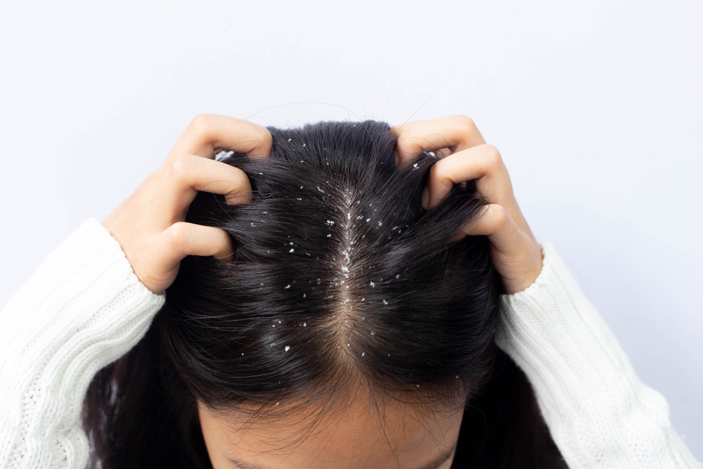 Dandruff: Know Which Type Is Making Your Scalp Flaky and Itchy