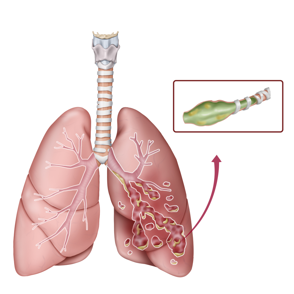 Bronchiectasis: All You Need To Know About It