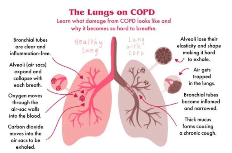 COPD explanation