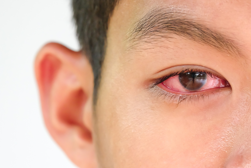 6 Different Types of Conjunctivitis and How To Treat Them