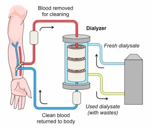 kidney dialysis