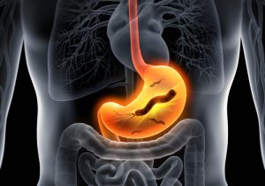 helicobacter pylori, h pylori infection in the stomach