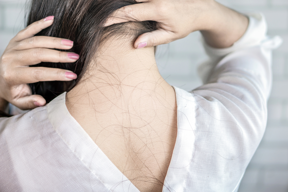 Asian women alopecia hair loss