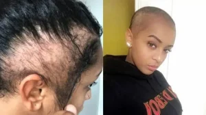 alopecia jada pinkett smith