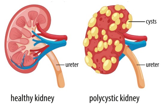 polycystic kidneys