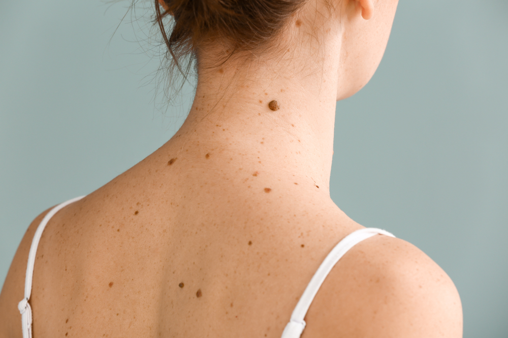 Moles: When Should I Be Worried?