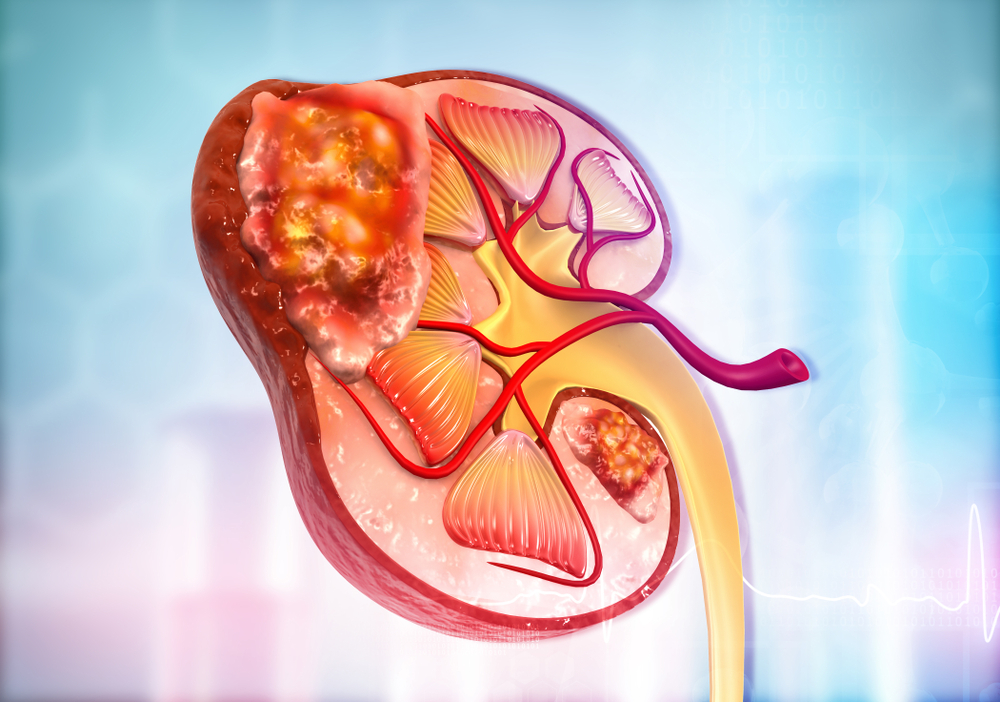 Kidney Cancer: Symptoms, Causes, Treatment