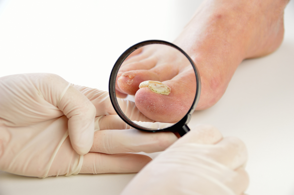 fungal nail infection, doctor examining a fungal toenail infection