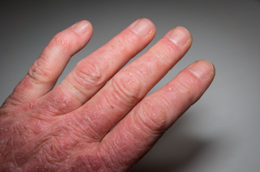 Psoriatic Arthritis: Summary of the Risk Factors, Symptoms, and Treatment