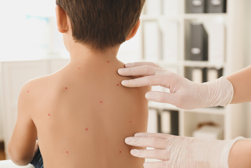 Chickenpox: Symptoms, Complications, and Treatment