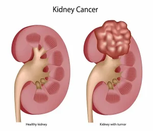 Kidney cancer