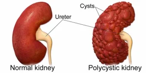 kidney cancer