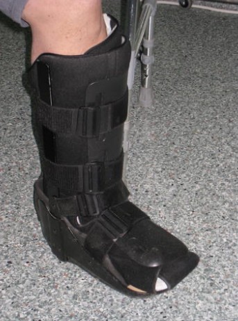 diabetic foot infection cast walkers