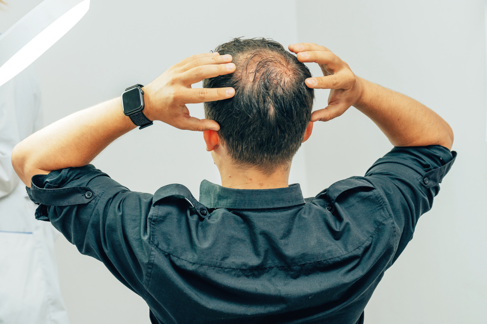 Male Pattern Baldness (Androgenetic Alopecia): Why Does It Occur?