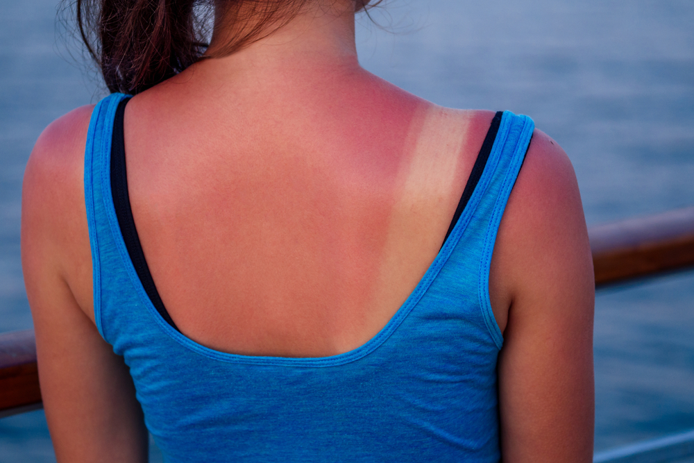 Sunburns: How To Manage Them?