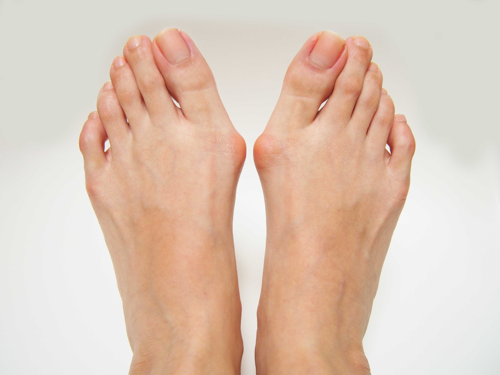 Why Do Bunions Form?