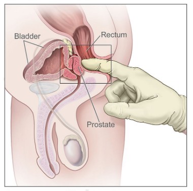 digital rectal examination (DRE) for prostatitis