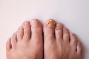 toenail fungus infection yellow toenails