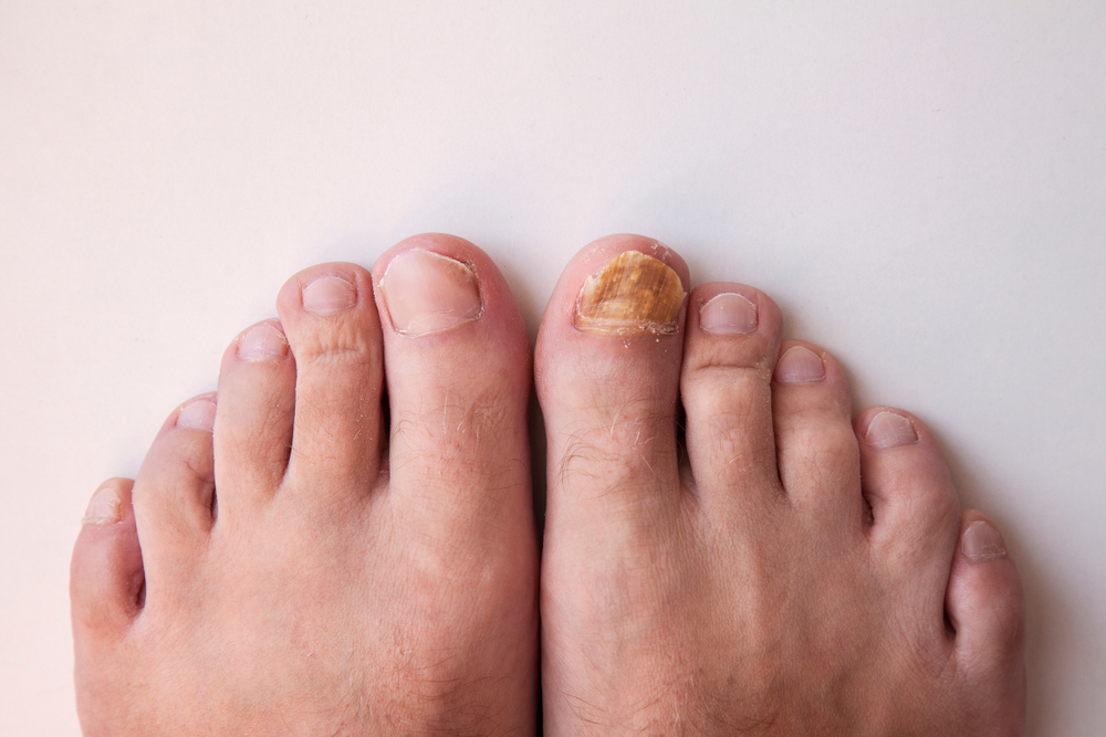 toenail fungus infection yellow toenails