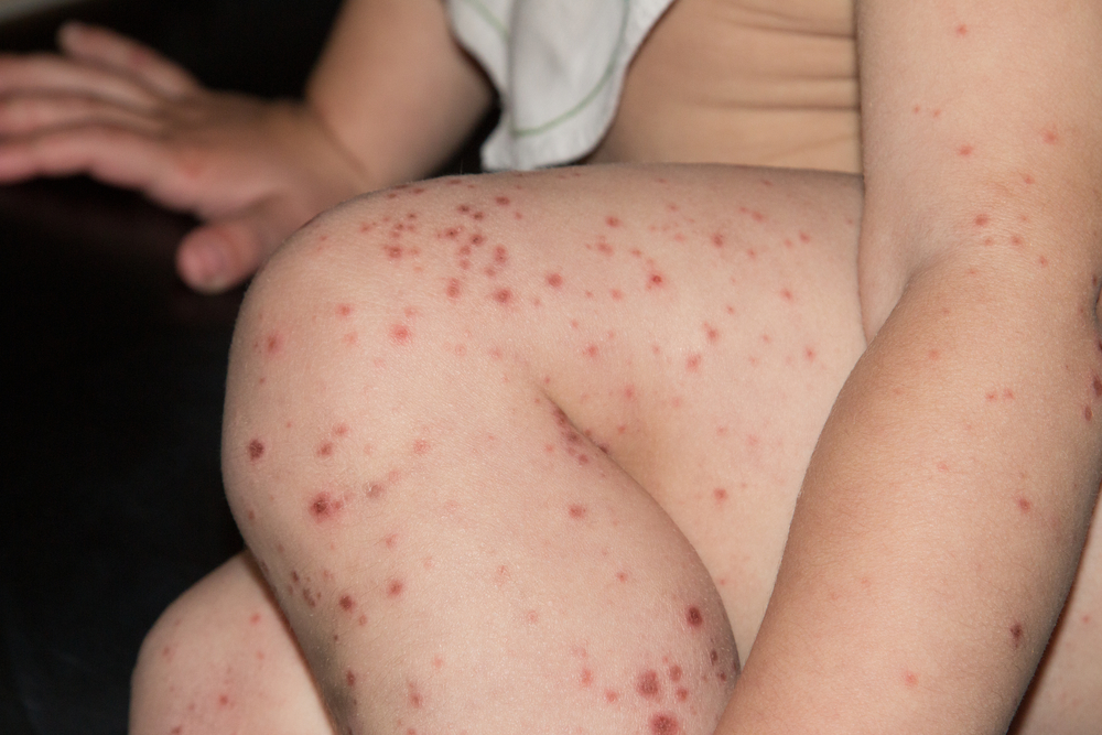 Hand, Foot and Mouth Disease: Can It Affect Adults Too?