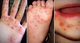 Hand Foot and Mouth Disease