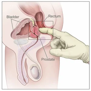 prostatitis