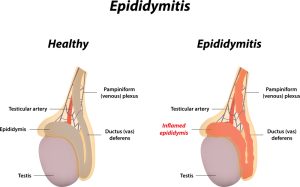 Epididymitis 