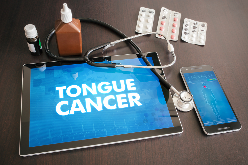 Southeast Asia: Highest Mortality Rate for Tongue Cancer