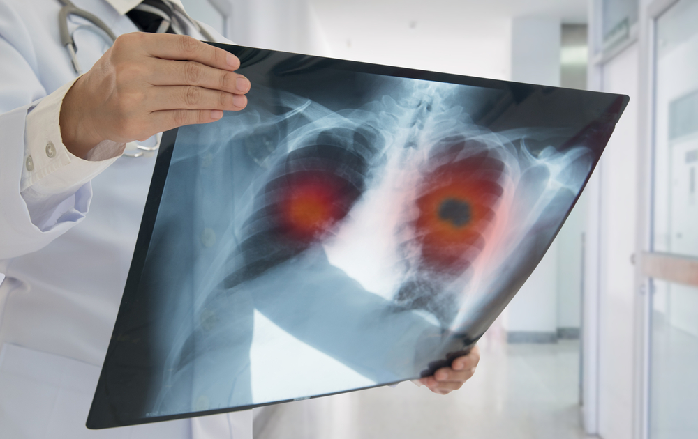 Pralsetinib: Targeted Therapies for RET-Fusion Positive NSCLC