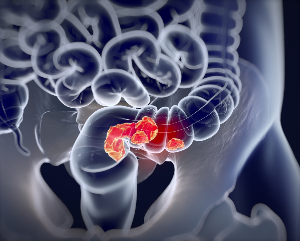 Asia Contributes to Highest Incidents of Colorectal Cancer