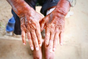 Scleroderma and Systemic Sclerosis