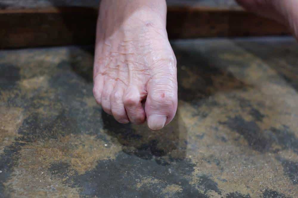 10 Common Foot Health Conditions Medical Channel Asia