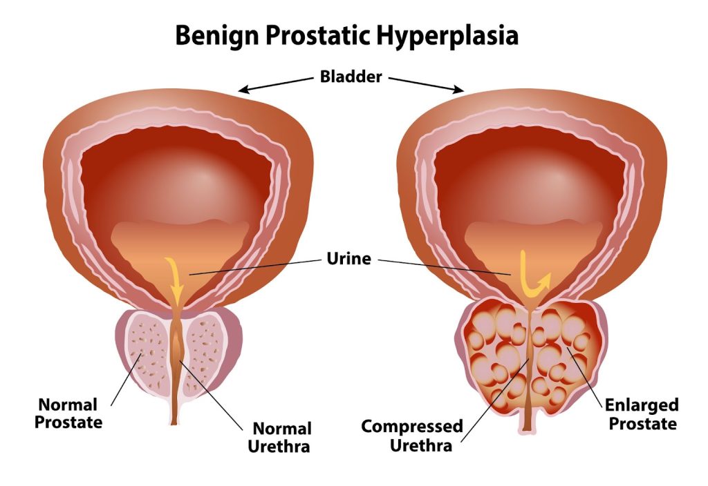 Benign Prostatic Hyperplasia / Hypertrophy