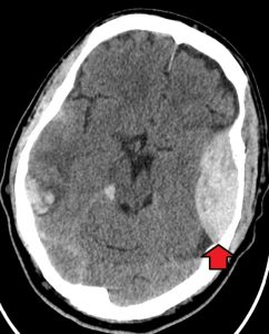  CT Brain: red arrow indicates bleeding typical of TBI