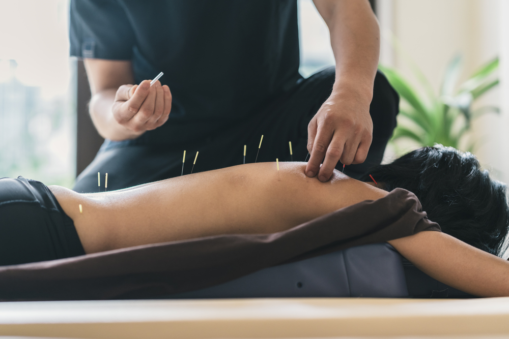 The Benefits of Acupuncture for Pain Relief