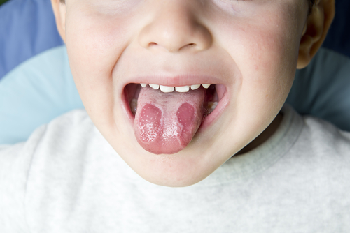 Uncovering the Mystery of Geographic Tongue
