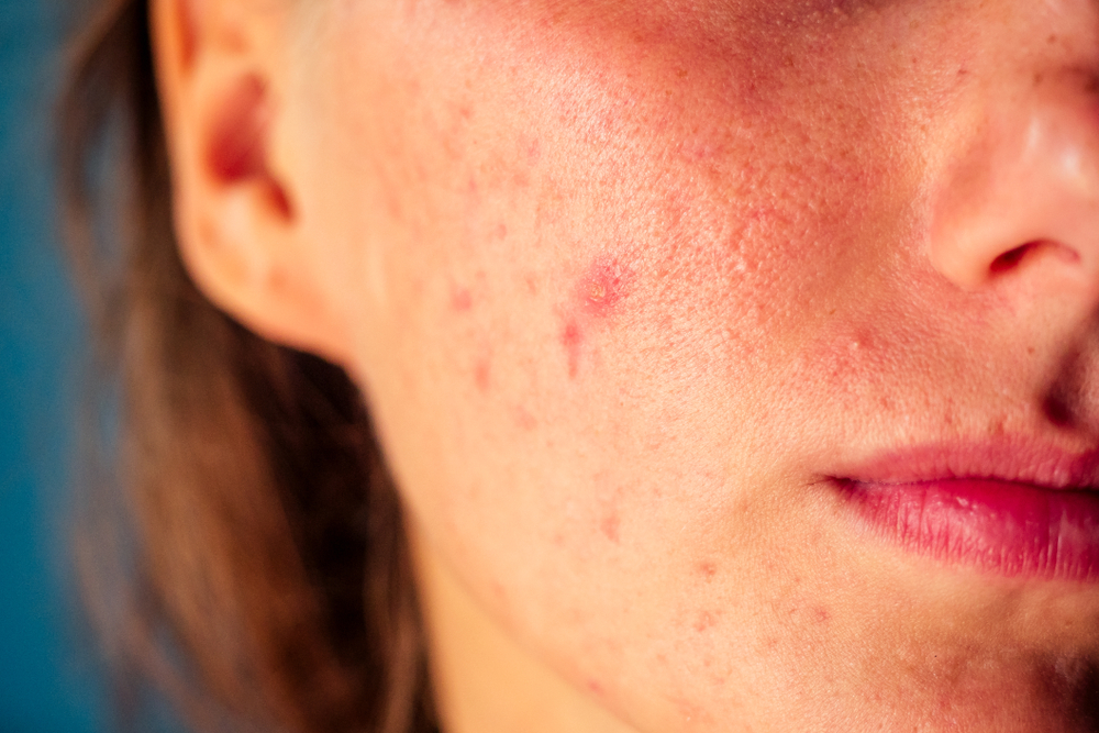 Understanding Acne: Causes, Treatments, and Prevention