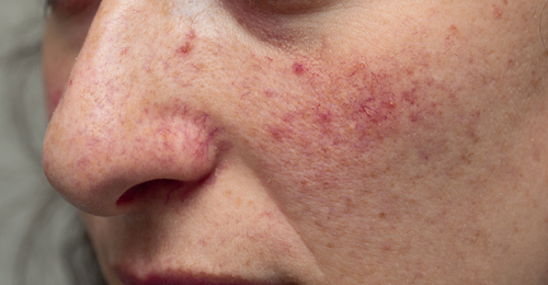 Unmasking Rosacea: The Blushing Truth Behind Mysterious Skin Condition